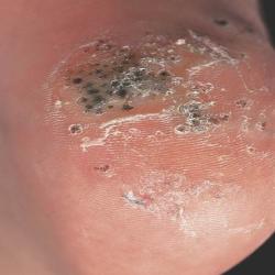 Example of skinLumpsAndBumps